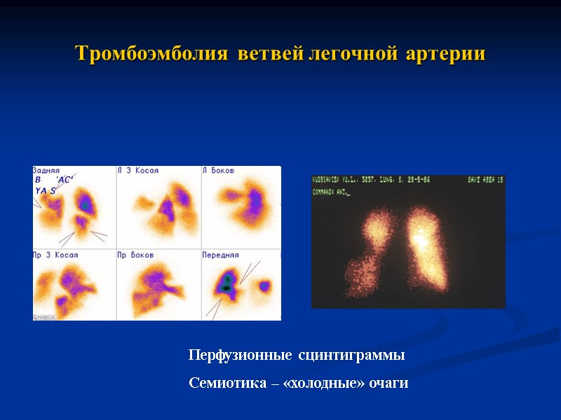 Тромбоэмболия ветвей легочной артерии Перфузионные сцинтиграммы Семиотика – «холодные» очаги